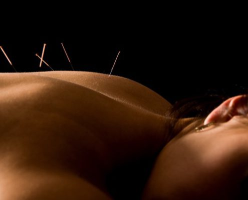 Ibiza Balance Therapy: Accupuncture
