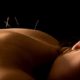 Ibiza Balance Therapy: Accupuncture